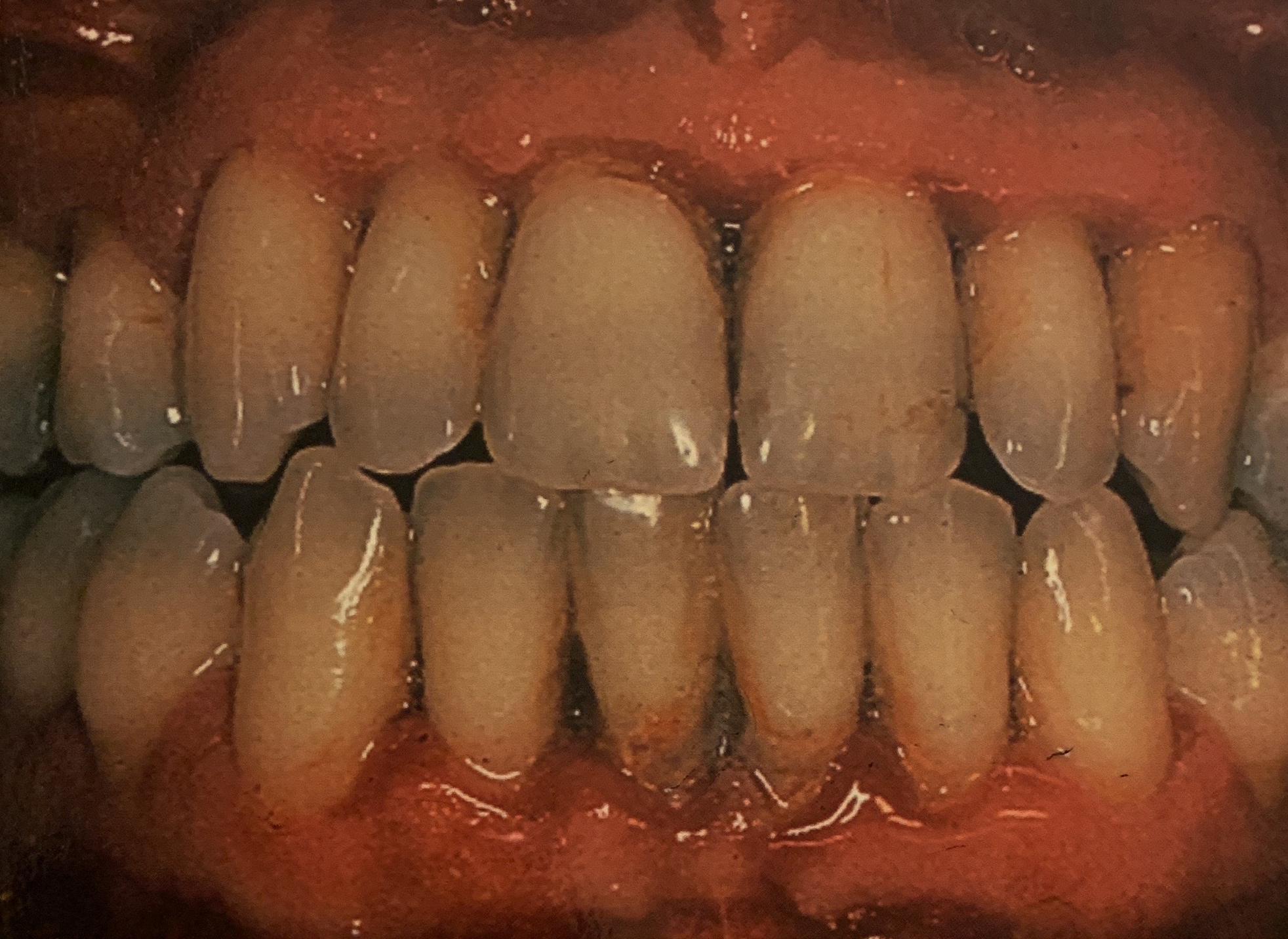 Gum Disease in Reston, VA