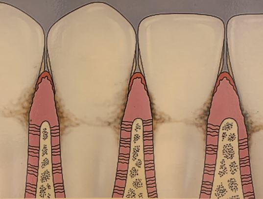 Gum Disease in Reston, VA