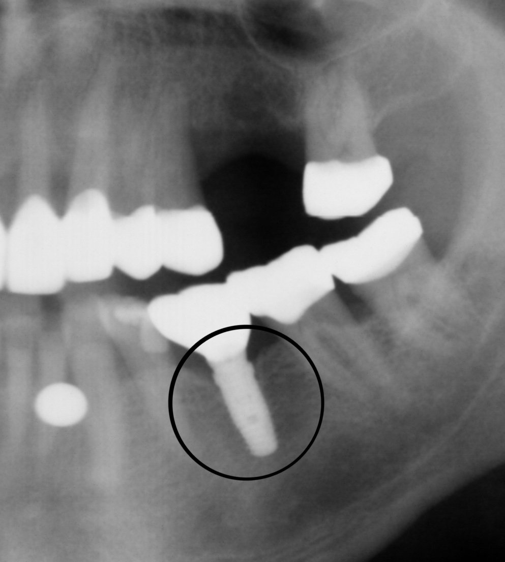 Implant X-Ray | Dental office in Reston, VA